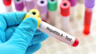 Hepatit A, Hepatit A virüsünün neden olduğu bir karaciğer enfeksiyonu