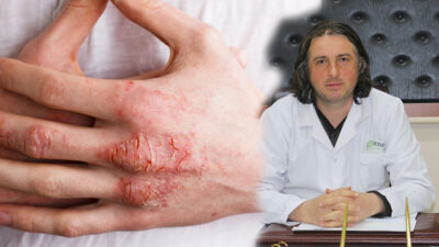 “Güneş sadece bronzlaştırmaz, cilde kalıcı hasar da verir” diyen Dr.