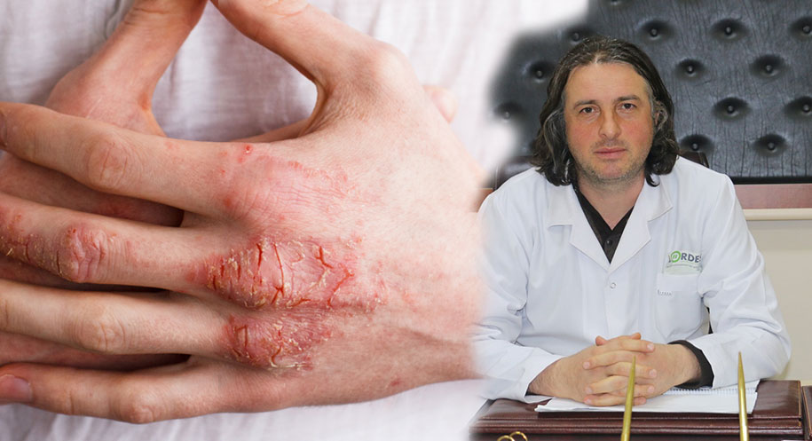 “Güneş sadece bronzlaştırmaz, cilde kalıcı hasar da verir” diyen Dr.